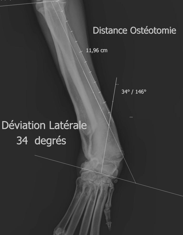 Ostéotomies Correctrices des Déformations Osseuses